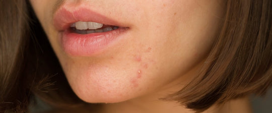 Skin Purging: la guida completa per riconoscerlo e gestirlo